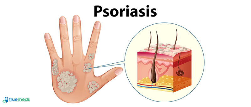 Psoriasis: 7 common triggers and how to avoid them